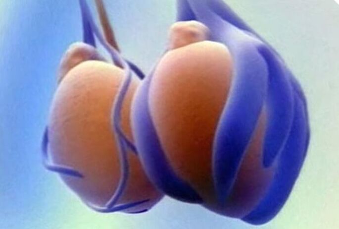 ভ্যারিকোসেল